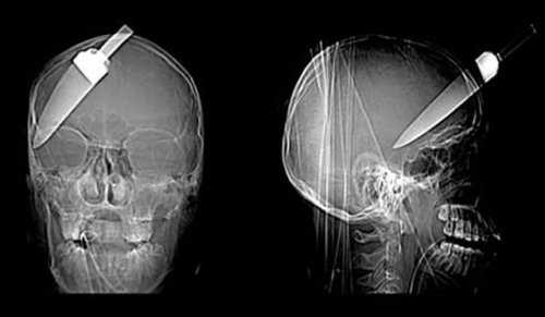 Настоящие рентгеновские снимки, которые шокируют и удивят вас (21 фото)