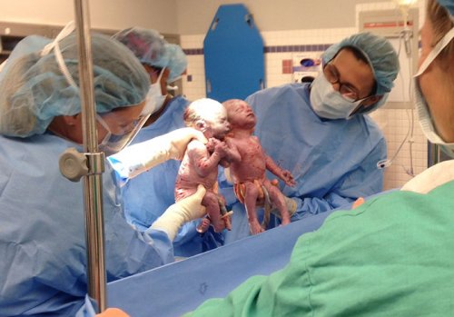 Родившиеся практически за руки близняшки спустя 2 года стали неразлучны (7 фото)