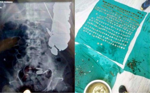 Человек-копилка: врачи извлекли из желудка мужчины 263 монеты и другие металлические предметы (2 фото)