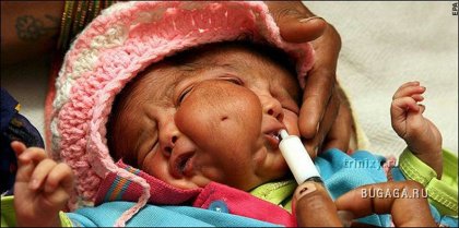 В Индии родилась девочка с двумя лицами