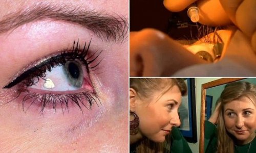 Женщина имплантировала себе в глаз платиновое украшение, чтобы прибавить себе уникальности (2 фото + видео)