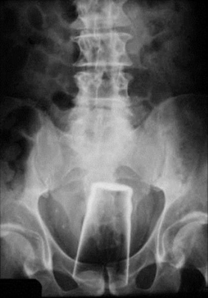 Настоящие рентгеновские снимки, которые шокируют и удивят вас (21 фото)