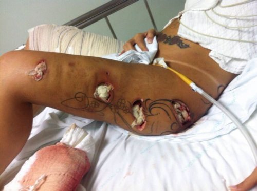 Участница конкурса попок Miss BumBum Андресса Урак пострадала после пластической операции (9 фото)