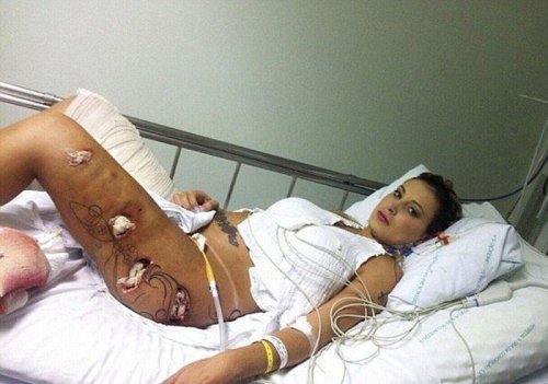 Участница конкурса попок Miss BumBum Андресса Урак пострадала после пластической операции (9 фото)