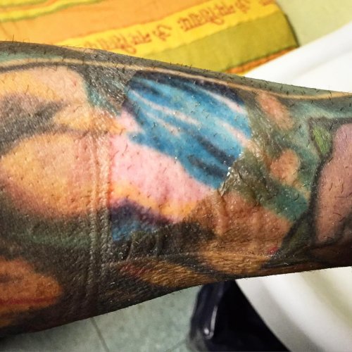 Татуировки на ожогах на руке