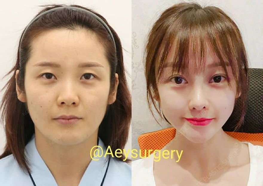 Корейцы до и после пластики фото