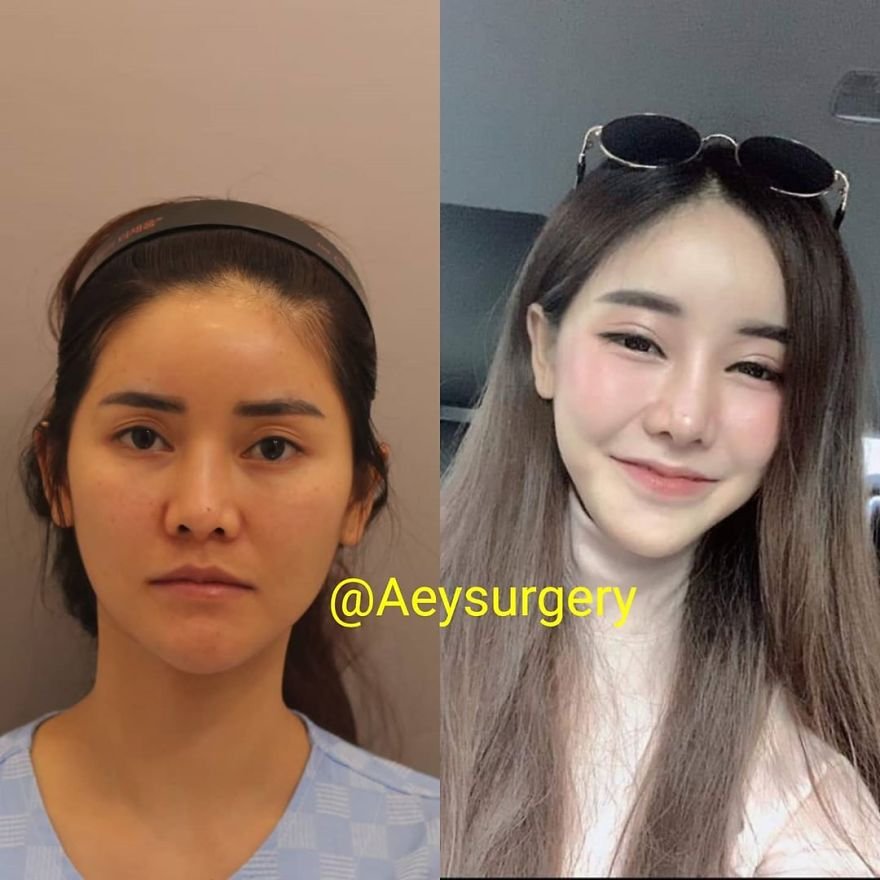 Фото до и после операции в корее до и после